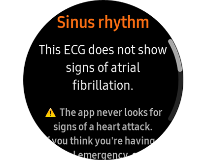 This ECG does not show signs of atrial fibrillation displayed on a Samsung smart watch